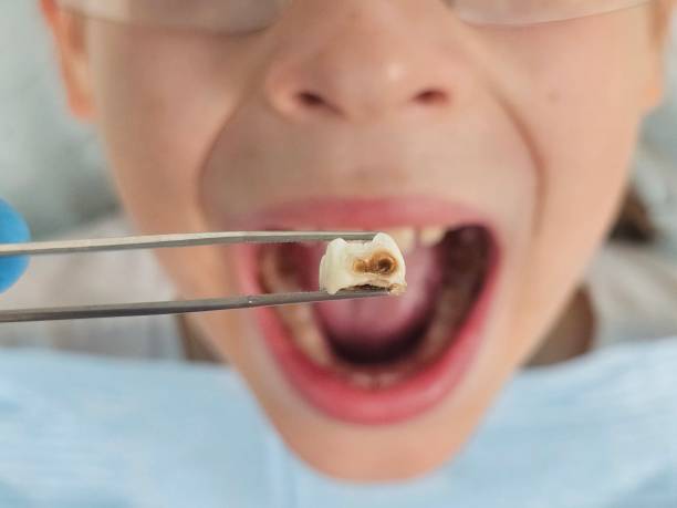 Best Dental Abscess Treatment in Cramerton, NC